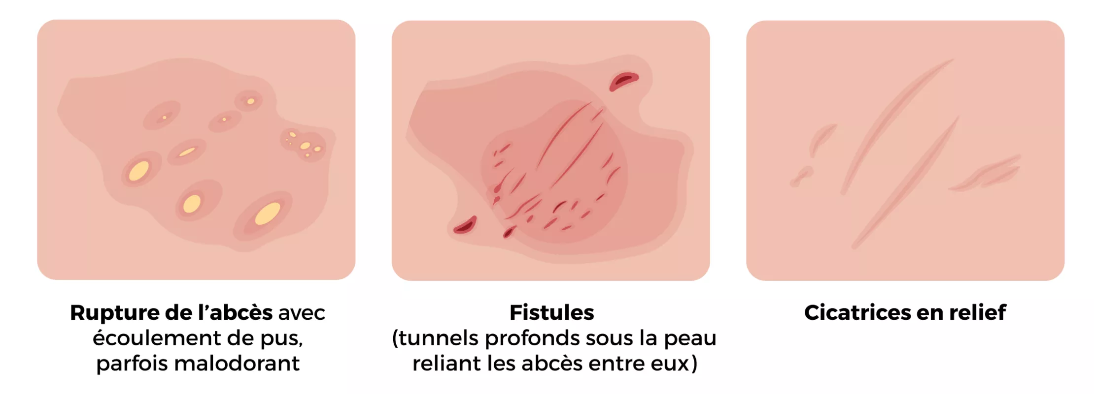 Symptômes