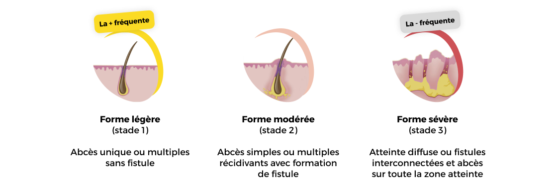 Les 3 formes (stades) de la maladie de Verneuil