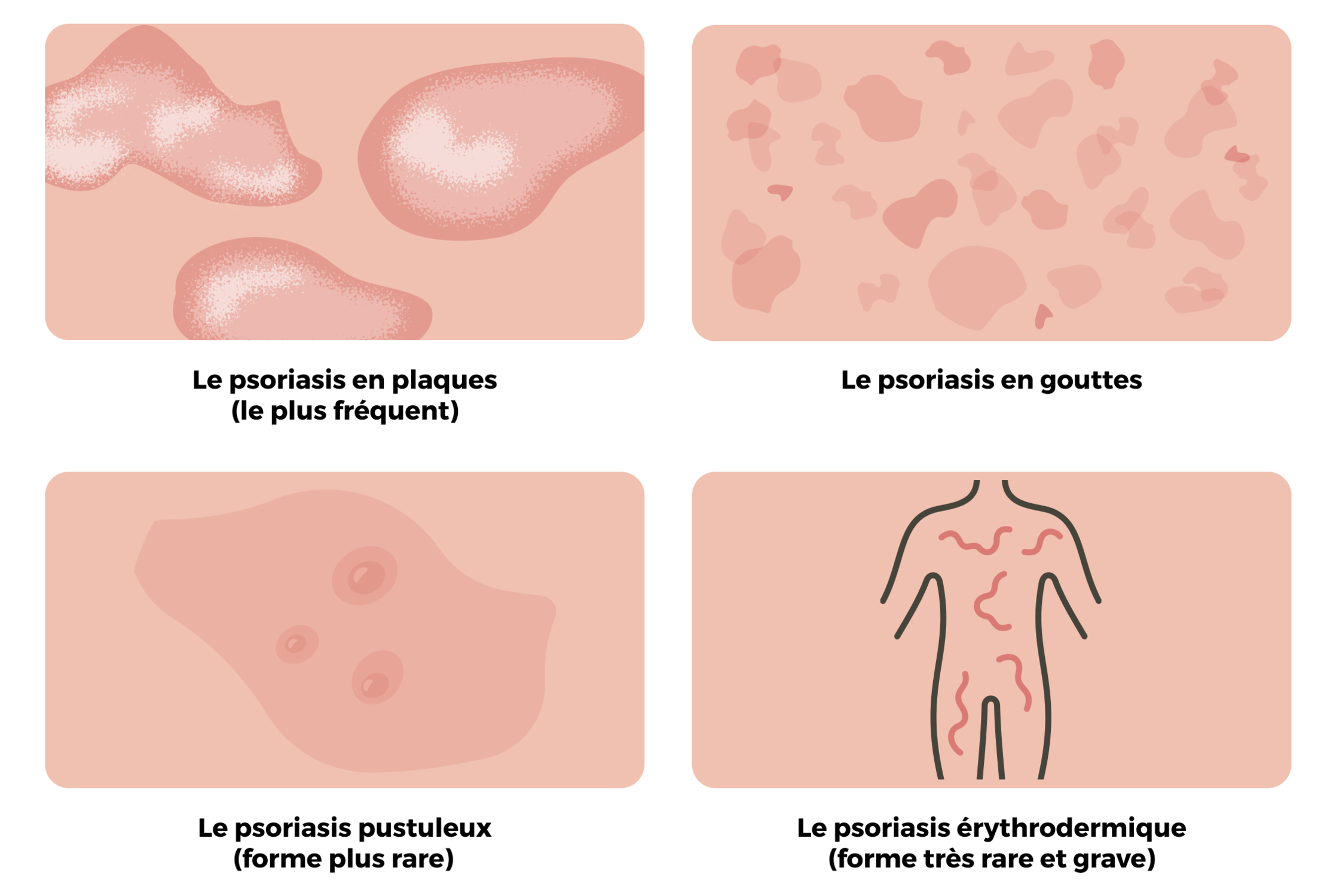 Différentes formes de psoriasis en image