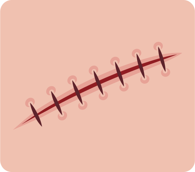 La suture primaire