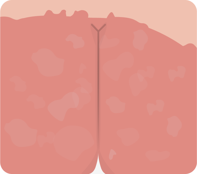 Le psoriasis des langes