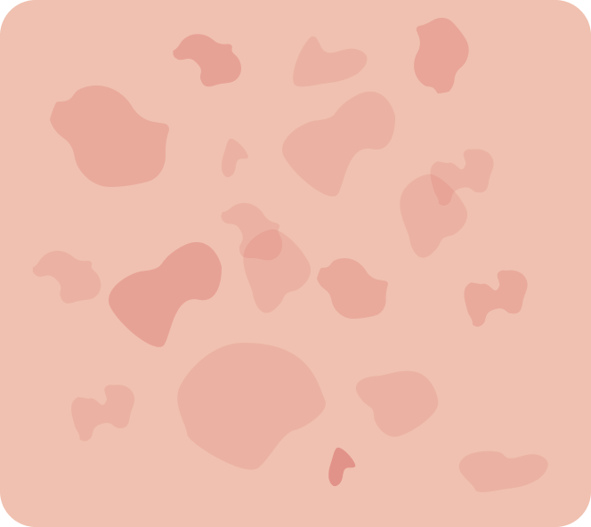 Le psoriasis en gouttes