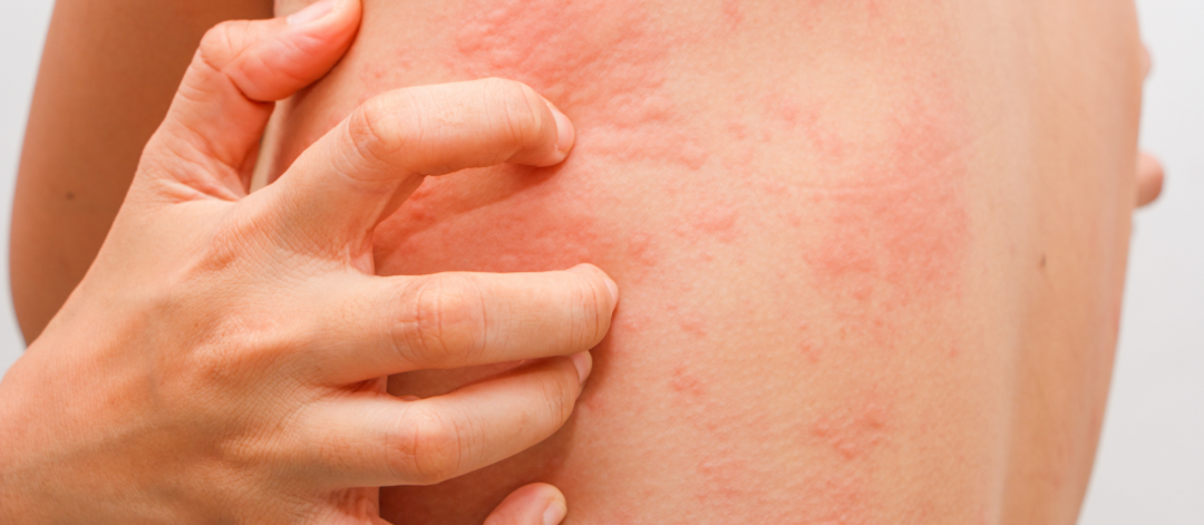 Peau et urticaire